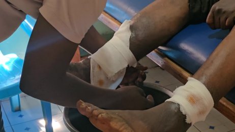 Stephen Odango’s wound treatment - we can see improvements on his eight year old wound (Jan 30th 2025)