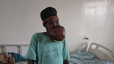 Meshack’s Update - the maxillofacial surgery (June 17th 2025).