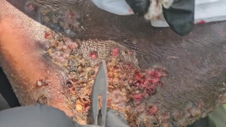 Elkana Opati jigger digging #1 - many visible bugs taken out whole (June 25th 2025) 
