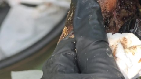 Elkana Opati jigger digging #2 - many visible bugs taken out whole (June 25th 2025) 