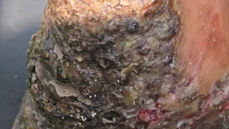 Mary Owendi's follow up jigger dig #2 - clusters of bugs (June 29th 2025)