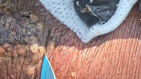 Mary Owendi’s follow up jigger dig #1 - clusters of bugs (June 29th 2025)