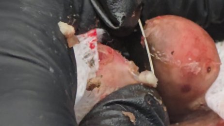 John Amukanga’s jigger digging #2 (July 15th 2025)