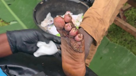 Principal runs towards our car, with jiggers, we tag him with John Amukanga for treatment (July 15th 2025)